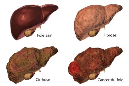 fibrose du foie espérance de vie.
